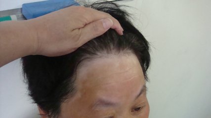 夏天白癜风患者要怎样做好皮肤防晒?