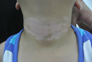 海口白癜风患者日常如何护理皮肤
