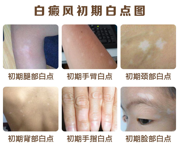 我们要怎么诊断是不是白癜风?