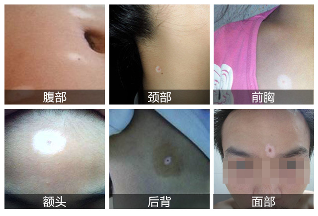 什么是白癜风?