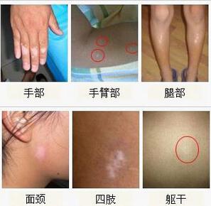 女人白癜风前期症状有哪些呢?