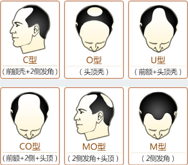 脱发常见症状有哪些?
