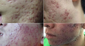 青春痘是什么原因导致的？