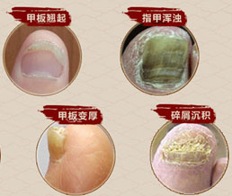 得了灰指甲正确的诊疗方法