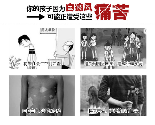 海口白癜风 用什么方法治疗儿童白癜风患者呢