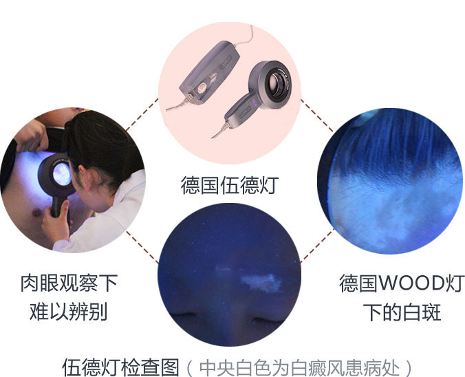 儋州wood灯检查白癜风费用_儋州白癜风医院