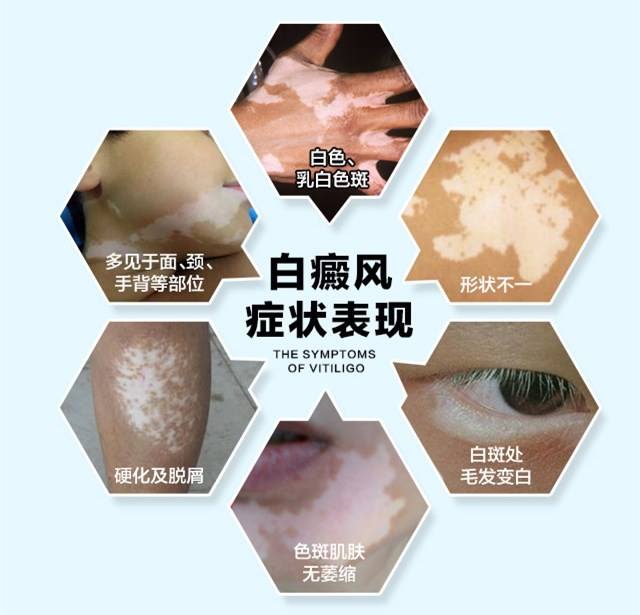 白癜风扩散有哪些症状