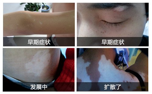 儿童患上白癜风去海口哪家医院治效果好