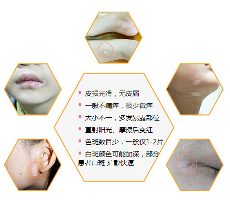 白癜风疾病有什么症状特点表现?