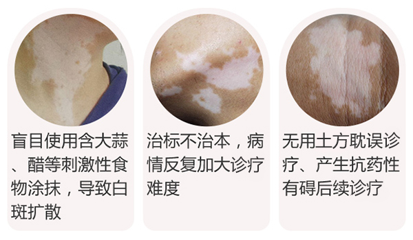 偏方真的能治好白癜风吗