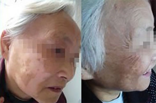 长在脸上的白癜风能自己恢复吗?看专业医师怎么说