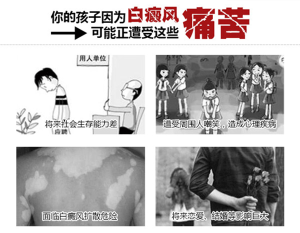 海口白癜风用药怎么注意